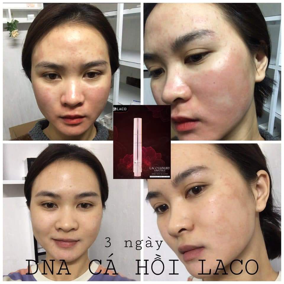 Ampoul DNA Cá Hồi Mờ Thâm, Nám ,Tàn Nhang, Sáng Da | BigBuy360 - bigbuy360.vn