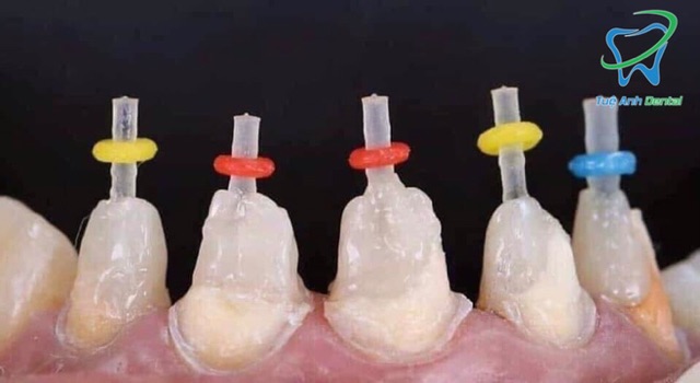 CHỐT SỢI TẠO CÙI