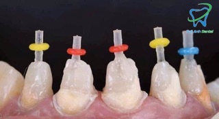 CHỐT SỢI TẠO CÙI