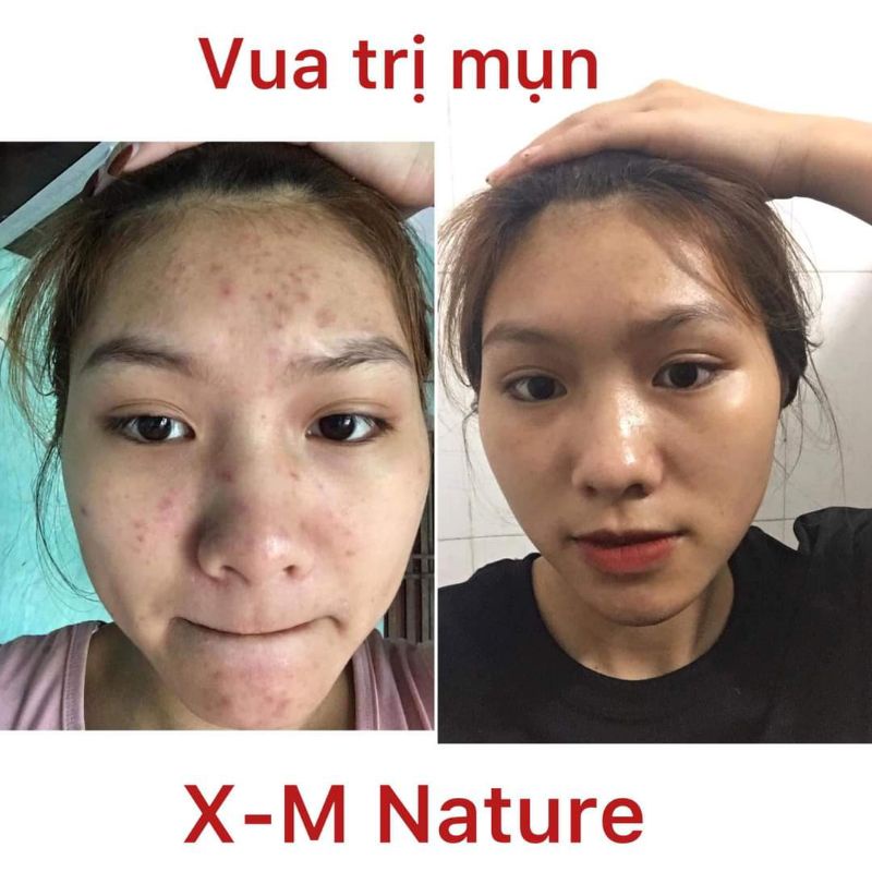 Srum mụn King acne Xm-Nature