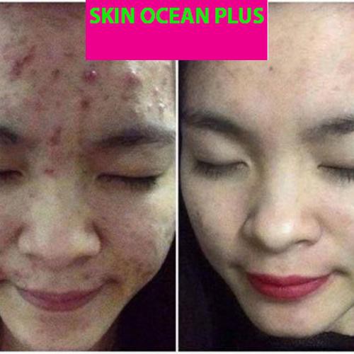 KEM TRỊ MỤN SKIN OCEAN PLUS - TRỊ MỤN TẬN GỐC , HIỆU QUẢ 99% -  NGĂN NGỪA TÁI PHÁT