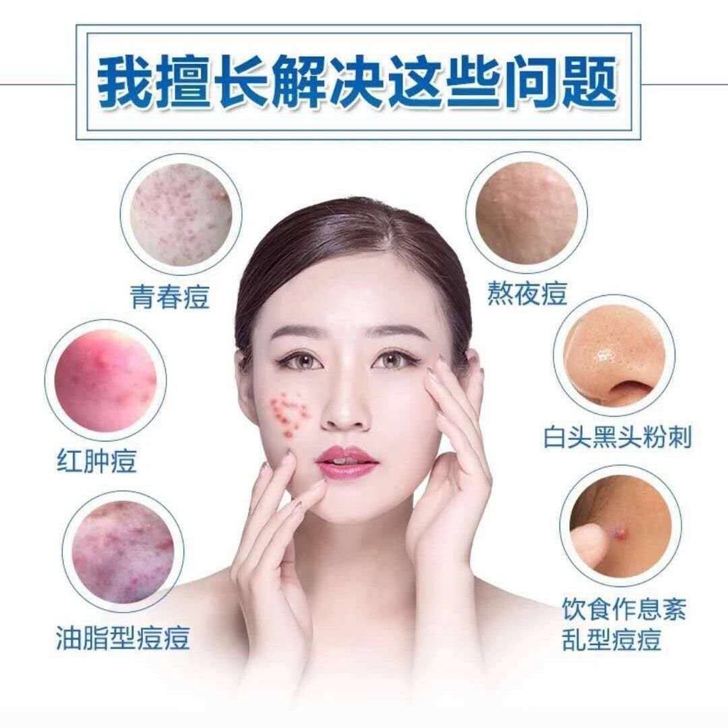 Kem Trị Mụn 20Gmaanshanzanzc.My11.27 Chuyên Dụng Chất Lượng | BigBuy360 - bigbuy360.vn