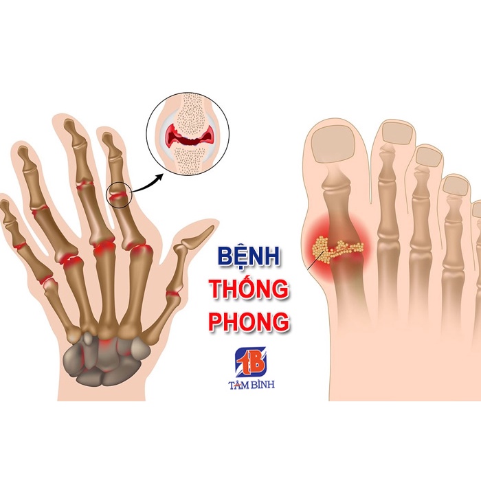 Thoái Hóa Gân Cốt Hoàn_Chuyên Đtri đau dây thần kinh tọa_thần kinh liên sườn và đau xương khớp