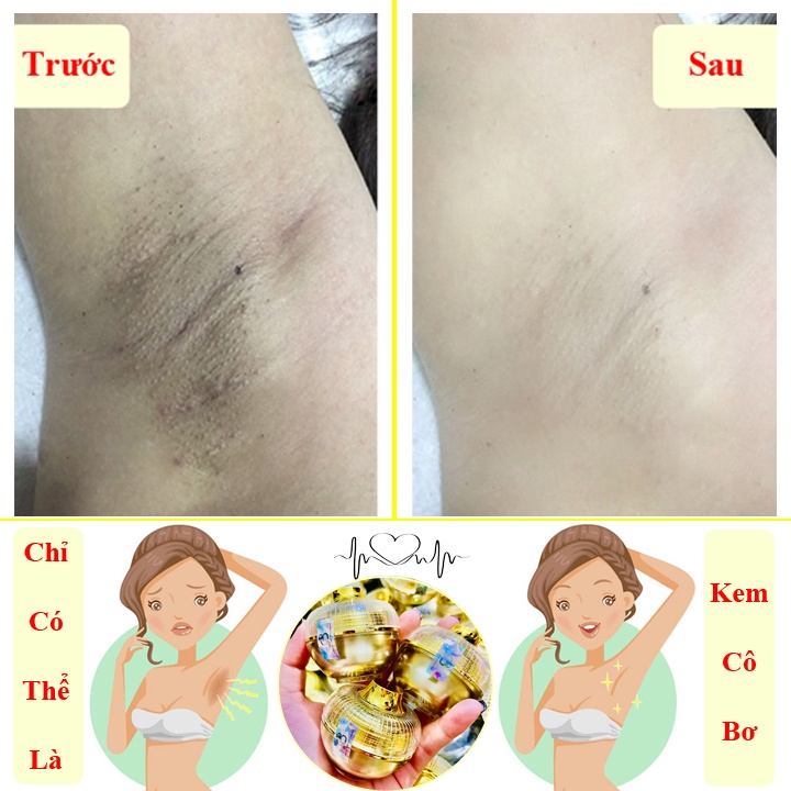 Kem Cô Bơ Lọ To 30gr Giảm Thâm Nách, Hết Hôi Nách Siêu Tiết Kiệm Giúp Loại Bỏ Mùi Hôi Dưỡng Trắng Nách