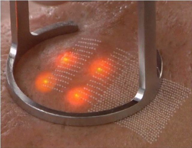 Máy  Laserco2 Fractionnal