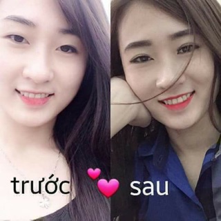 Kích mí lưới