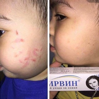 Kem Sẹo Nga Klirvin