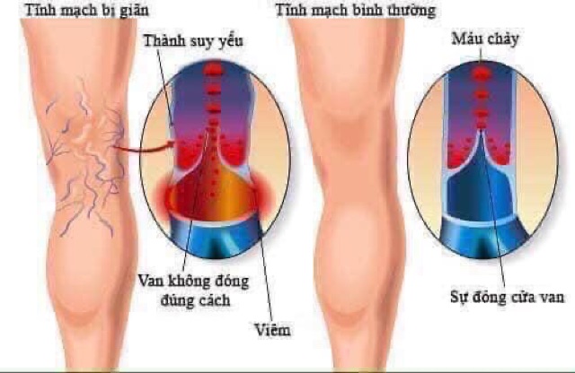 Kem Varikosette Chữa Suy Giãn Tĩnh Mạch của Nga