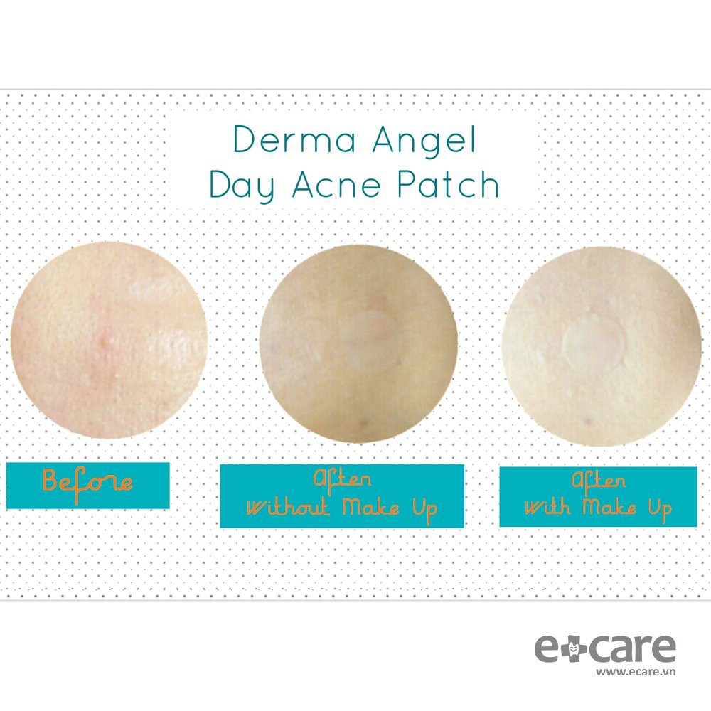 Miếng Dán Mụn Ban Ngày và Ban Đêm Derma Angel