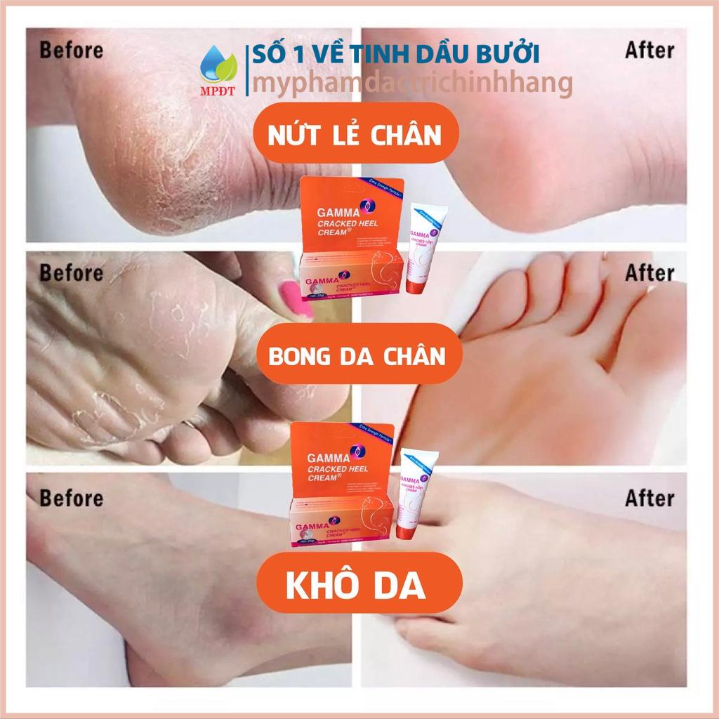 Kem giảm nứt gót chân dưỡng ẩm, dưỡng da chân làm mềm