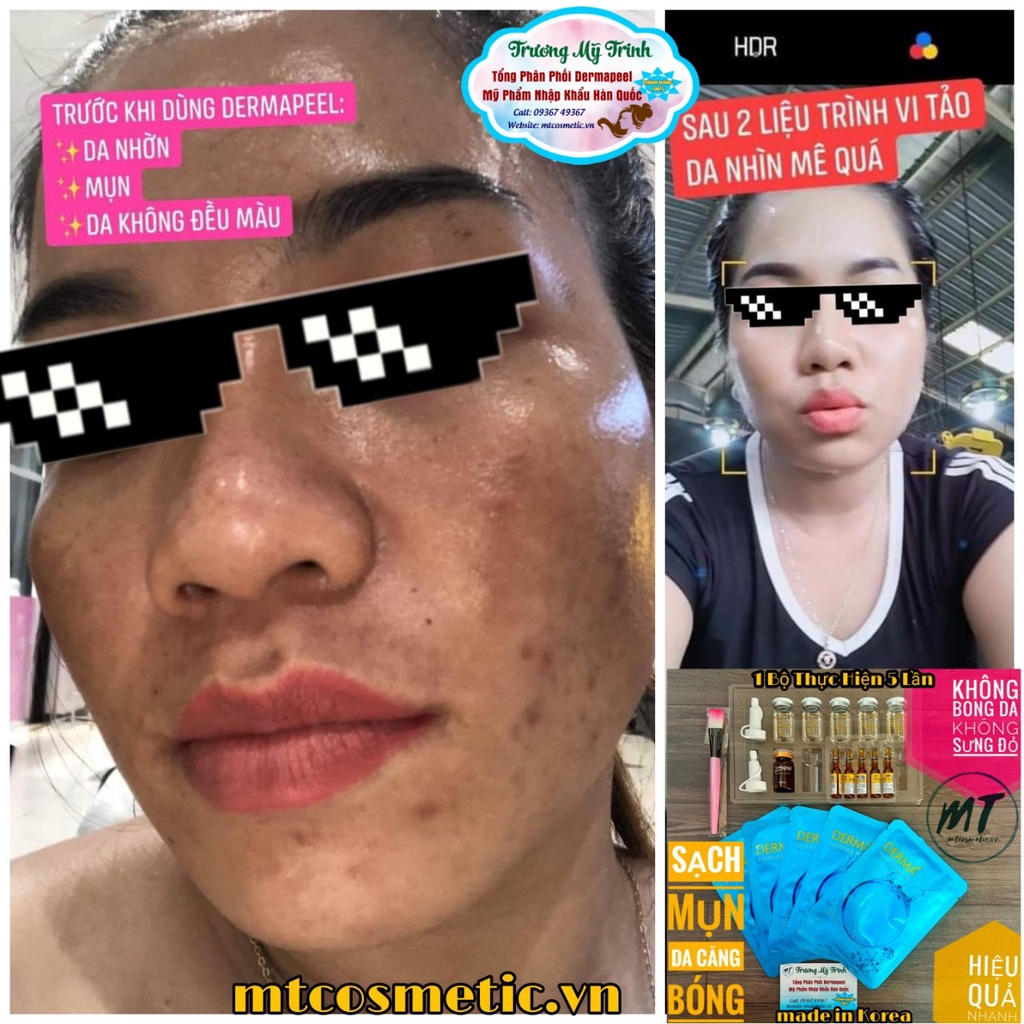 BỘ Vi Tảo Trứng Cá Tuyết Dermapeel+ - Combo Trẻ Hóa Làn Da - SẠCH MỤN - MỜ THÂM NÁM - DA CĂNG BÓNG - 5 NẠ DERMAPEEL