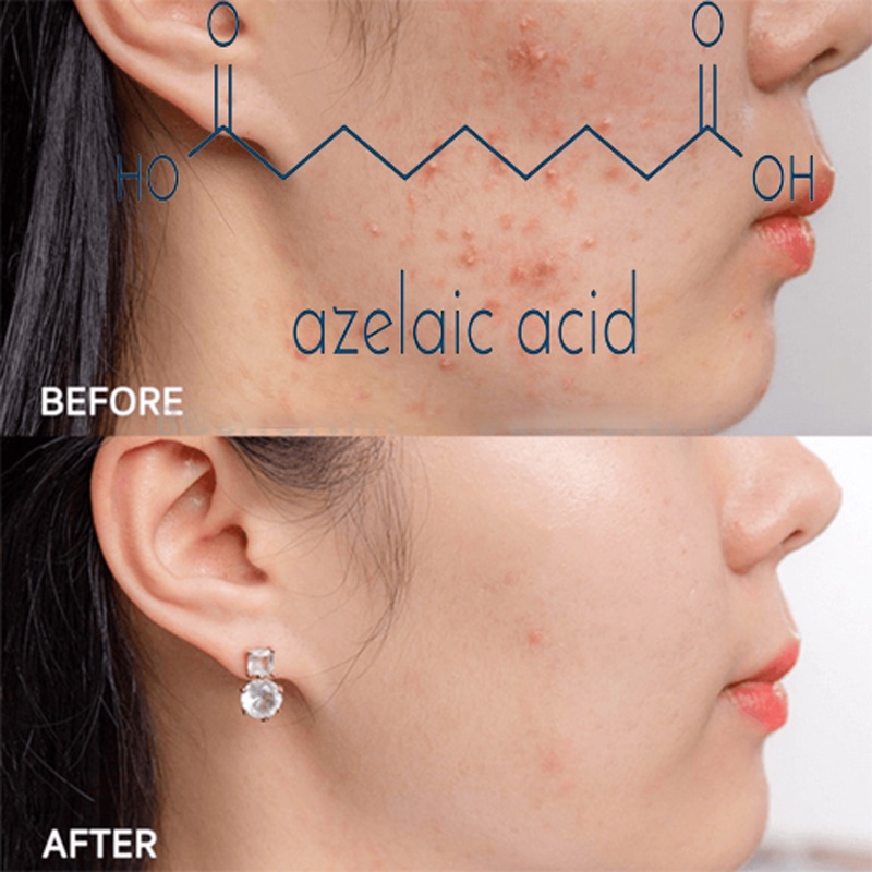 Kem Giảm Mụn Làm Trắng Da Acne Derm 20% Axit Azelaic 20g