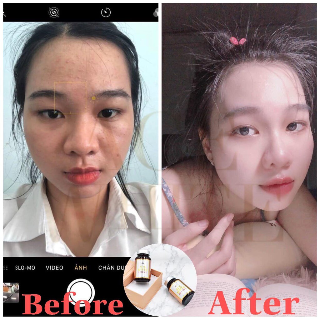 [COLLAGEN ĐẸP DA] Viên uống trắng da Collagen Ace White giúp giảm thâm, mờ nám, dưỡng trắng hồng hào, dưỡng trắng da mặt | BigBuy360 - bigbuy360.vn