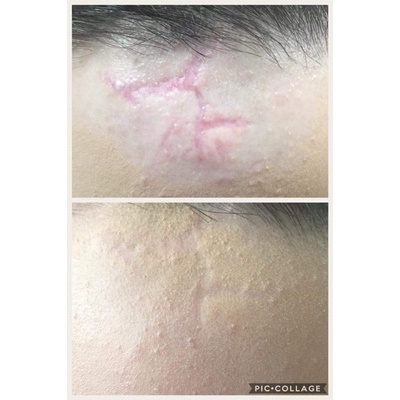 Kem Mờ Sẹo Lồi/Phẫu Thuật/Tai Nạn/Bỏng Rejuvsil 10ml Chính Hãng- Rejuvasil