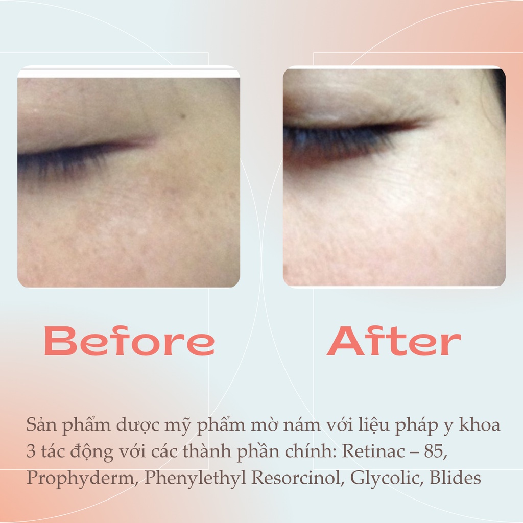Serum mờ thâm nám Vitara Anti Melasma Spot loại bỏ các đốm đen làm sáng da 10g