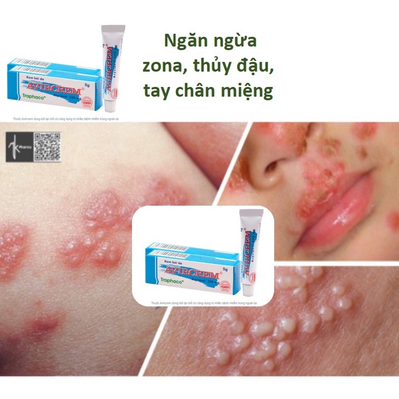 Kem bôi THUYDAU ZONA✅ ngăn ngừa viêm da, mụn rộp, zona, thủy đậu, tay chân miệng
