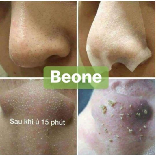 Ủ Mụn Youngerc - Đẩy tan mọi loại mụn - Siêu phẩm ủ mụn | BigBuy360 - bigbuy360.vn