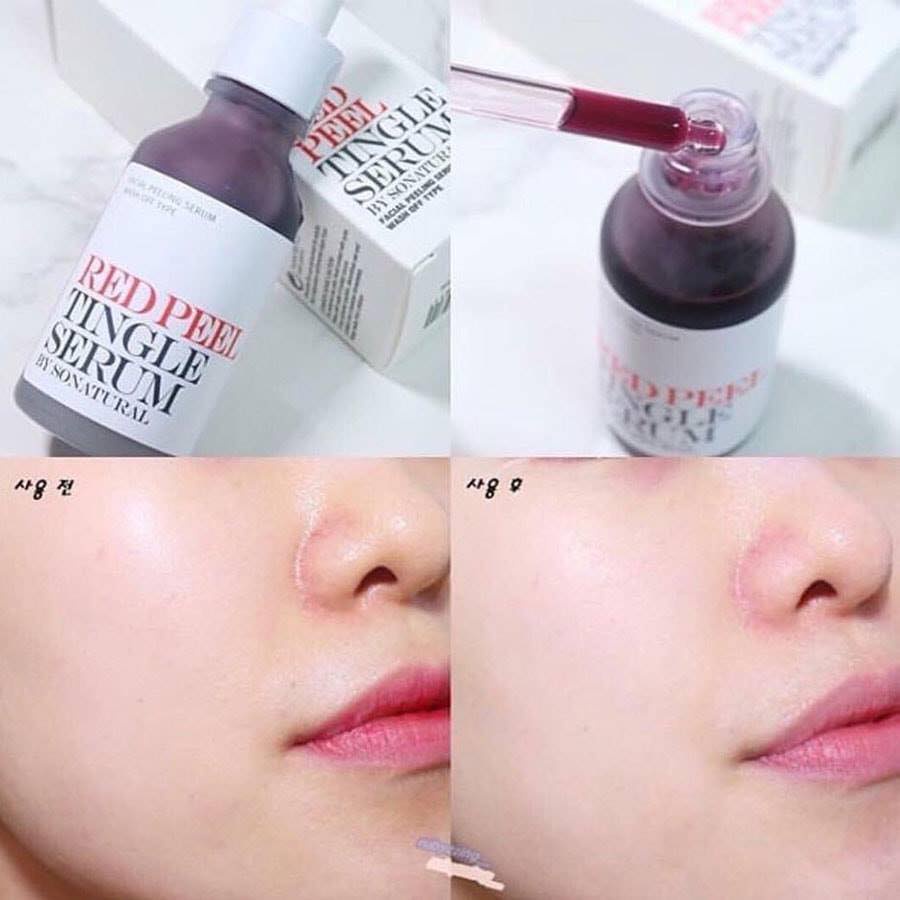 Red Peel Tingle Serum 35ml/10ml Tinh Chất Tái Tạo Da Chính Hãng So Natural