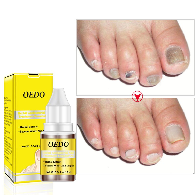 OEDO Dầu dưỡng móng tay chống nấm móng chân, chân chống nấm, diệt khuẩn
