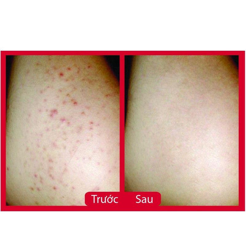 Serum Ngừa Thâm - Thâm Chân Tay - Nách- Bẹn