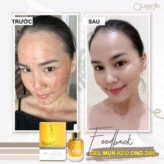 [Chính Hãng] GEL MỤN KEO ONG 24H