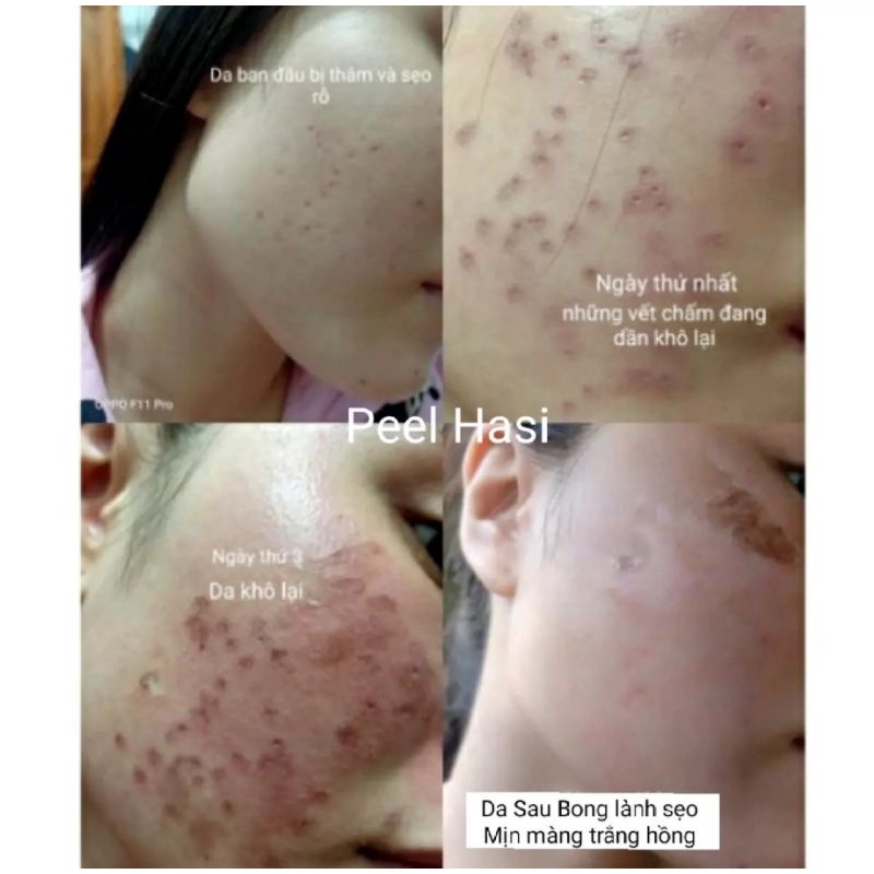 Feel HASI Quét Nám Tàn Nhang.Đầy Sẹo Rỗ Lâu Năm