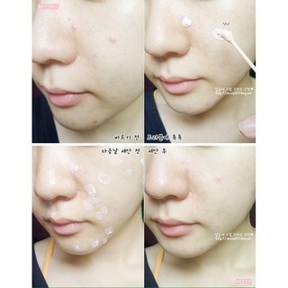 Chấm mụn bye bye blemish