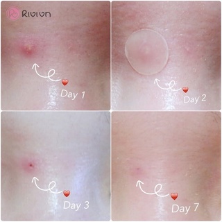 Miếng Dán Mụn Cosrx Acne