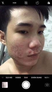 Tái tạo da Phương Anh