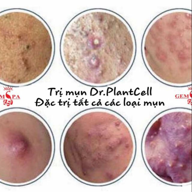 Tiêu cồi mụn 24h