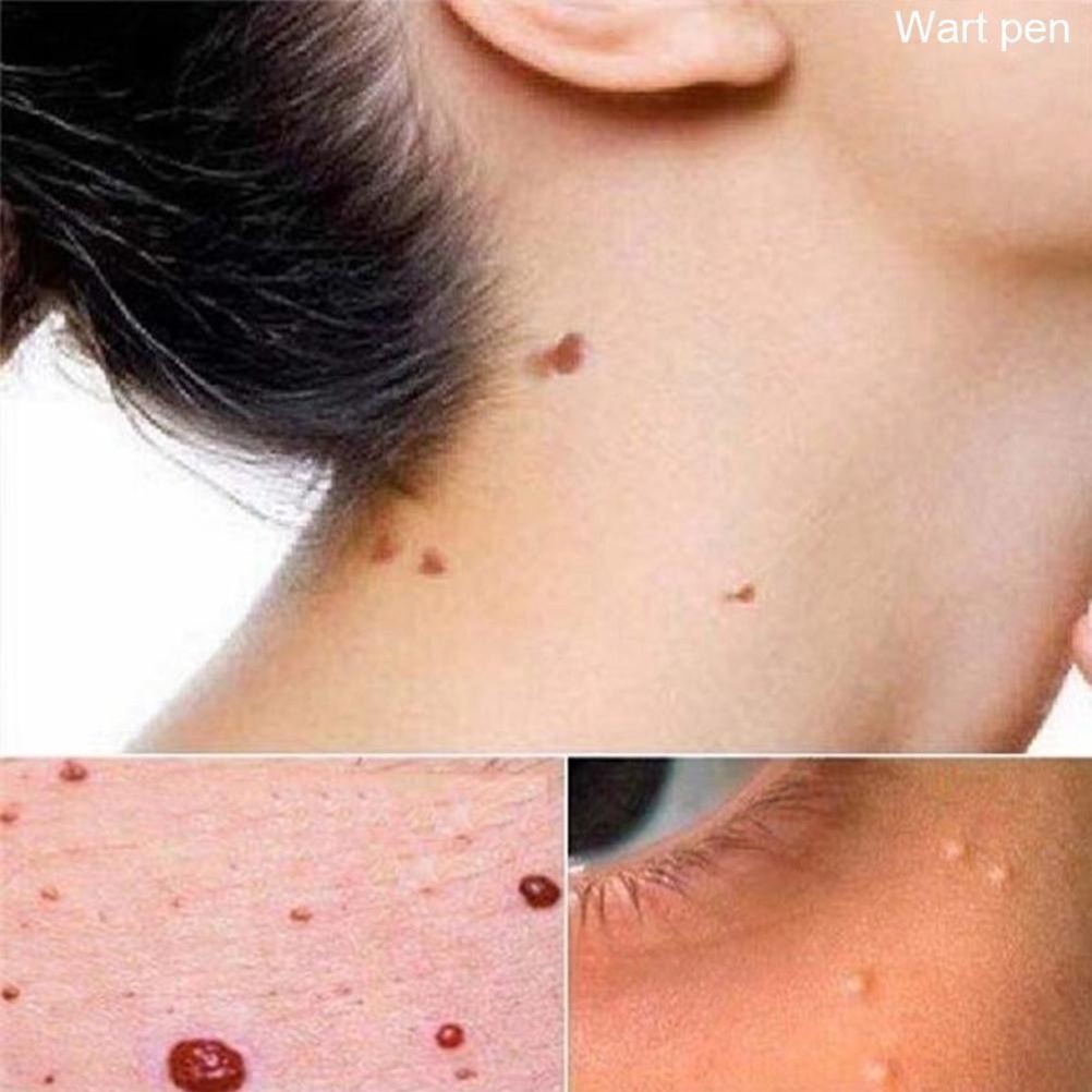 (Hàng Mới Về) Dung Dịch Loại Bỏ Mụn Thịt Nhanh Chóng 3ml | BigBuy360 - bigbuy360.vn