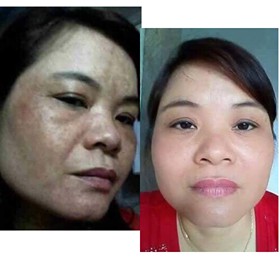 💗 MỚI 💗 Hết Nám Tàn Nhang Lâu Năm Nhờ Serum Pukel Plus