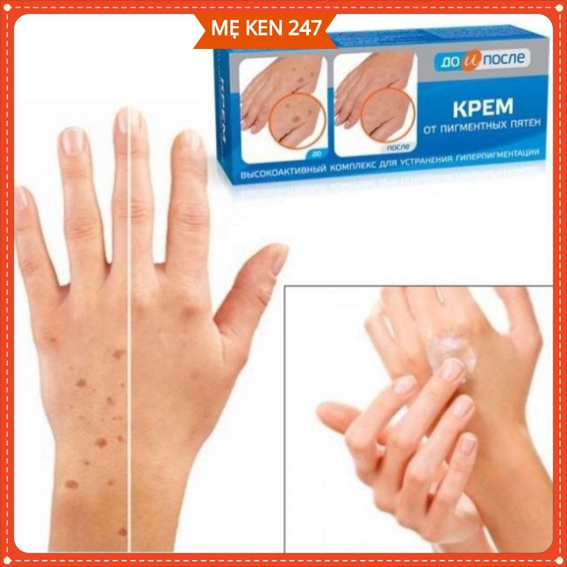 Kem đồi mồi kpem Nga 50ml xóa mờ đồi mồi tay, tàn nhang dưỡng da tay trắng sáng mịn màng