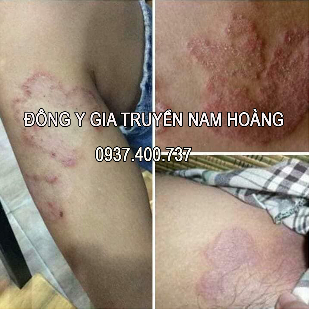 Thuốc_Hỗ_Trợ_Chữa_#Nấm_Móng_Tay_Chân,#Viêm_Da_Cơ_Địa,#Tổ_Đỉa,#Viêm_Da,#Hắc_Lào,#Lang_Ben,#Vảy_Nến,#Bong_Tróc_Da