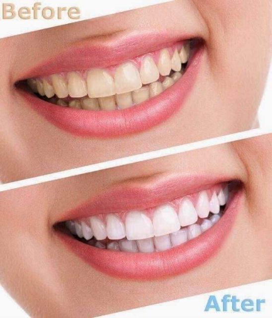 BỘT THAN TRE HOẠT TÍNH TRẮNG RĂNG CAO CẤP ZENPALI ( Tặng 1tuyp kem đánh răng SENSODYNE )