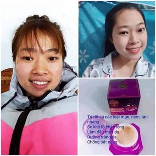 combo 5 hộp face mụn( mua 10hộp tặng 1 hộp)