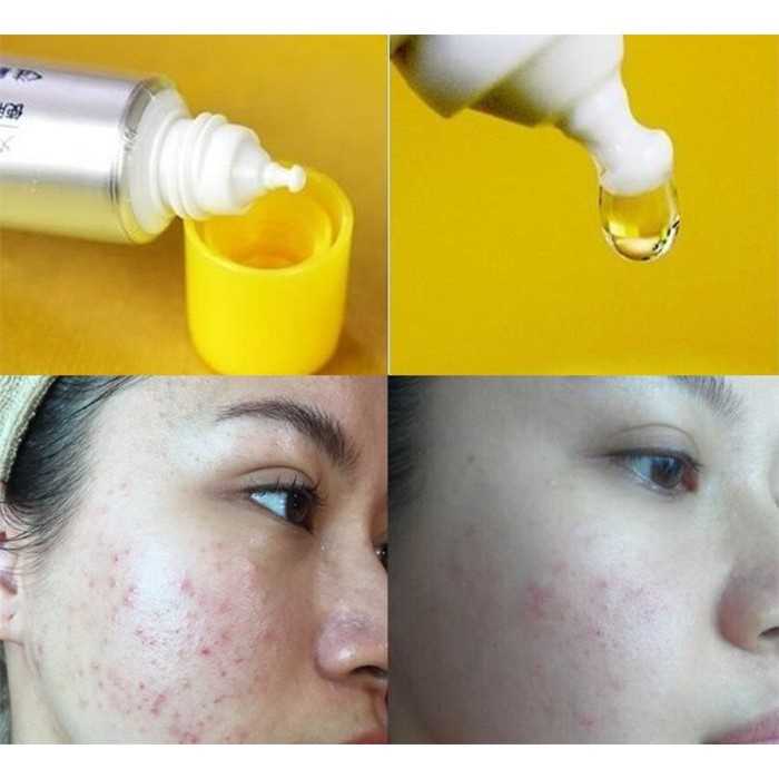 Serum Giảm Thâm, Nám, Mụn Vitamin C Melano CC Rohto Nhật