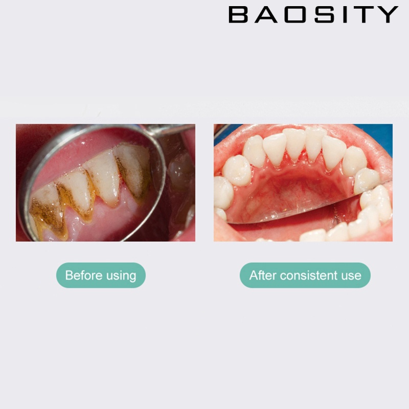Máy cạo vôi răng siêu âm 2 đầu tiện dụng thông minh loại bỏ vết ố răng