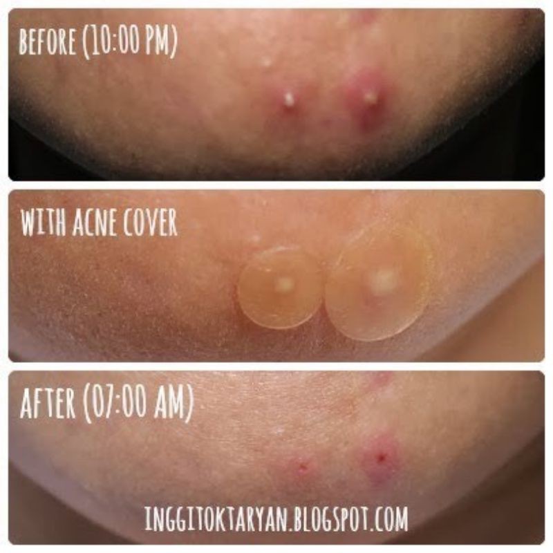 Miếng Dán Mụn Sưng Cosrx  Acne Pimple Master Patch Màu Đỏ & Clear Fit Master Patch Màu Đen