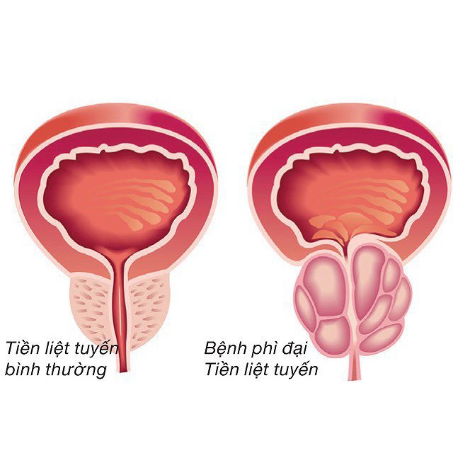 Tiền Liệt Tuyến Á Âu - Hỗ Trợ Giảm Kích Thước và Sự Phát Triển U Xơ Tiền Liệt Tuyến, Tiểu Đêm