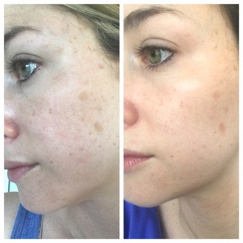 Serum THE ORDINARY Axit Lactic 10% / 5% + Ha 2% | Axit Lactic 10% / 5% + 2% 30ml chăm sóc da