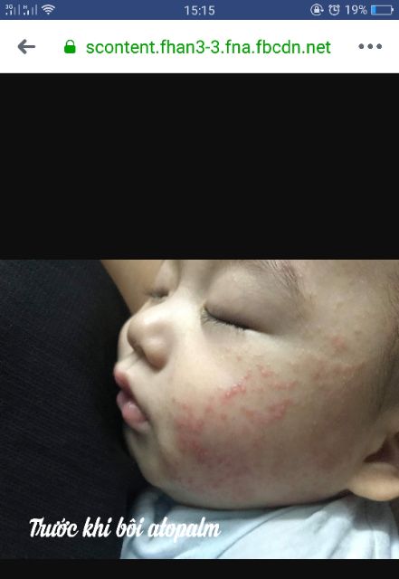 Kem Atopalm 100ml [ nhập khẩu chính hãng date 2023] | BigBuy360 - bigbuy360.vn