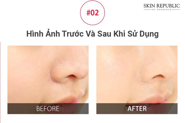 Sáp Trị Mụn Đầu Đen Red Peel Clear Stick Pore Blackhead & Face So'Natural Hàn Quốc l Chính Hãng Hàn Quốc