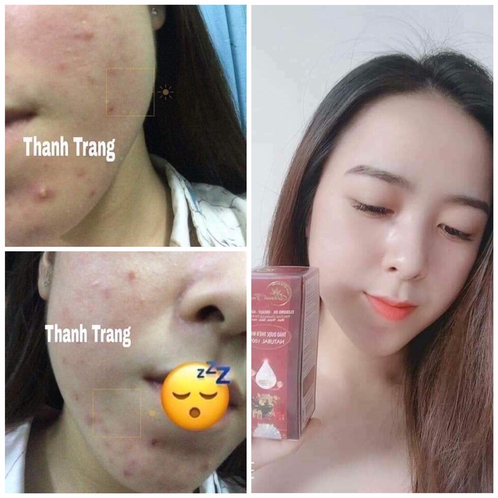 Dung Dịch Mụn Nám Thanh Trang - Thảo Dược Trừ Mụn Thâm Nám Sẹo Rỗ - Tái Tạo Da Thanh Trang