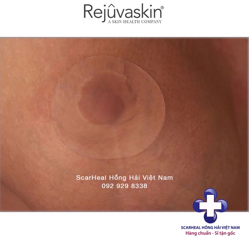 [Mã LTBAUAB10 giảm 7% đơn 99K] Miếng dán xóa mờ sẹo phẫu thuật ngực Rejuvaskin Scar FX 3″ Breast Circle