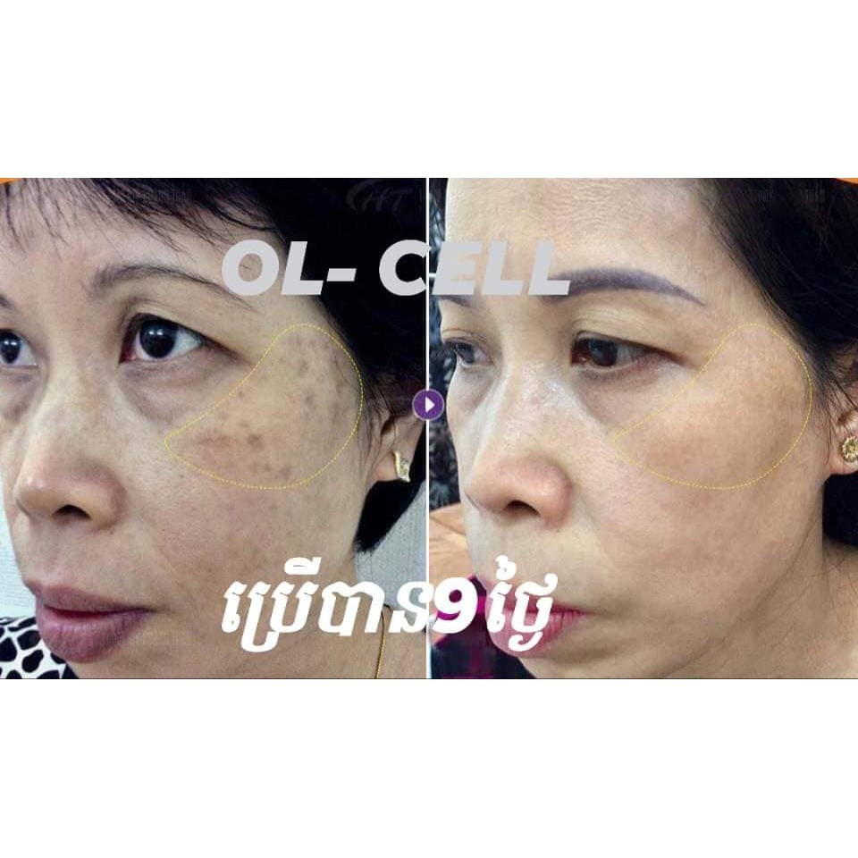 Đ𝐚̣̆𝐜 𝐓𝐫𝐢̣ hoàn toàn 𝐍𝐚́𝐦, tàn nhang, đồi mồi khỏi trong 3 tháng 𝐎𝐋_𝐂𝐄𝐋𝐋 | BigBuy360 - bigbuy360.vn