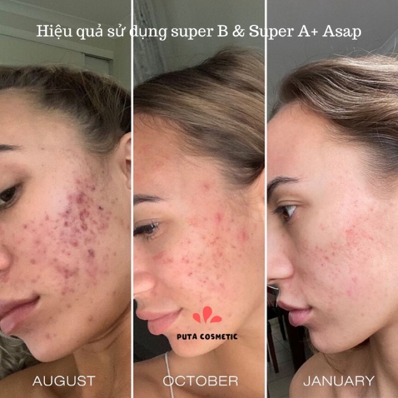 Tinh chất serum tái tạo da ngừa mụn mờ sẹo nhăn thâm Asap super B complex