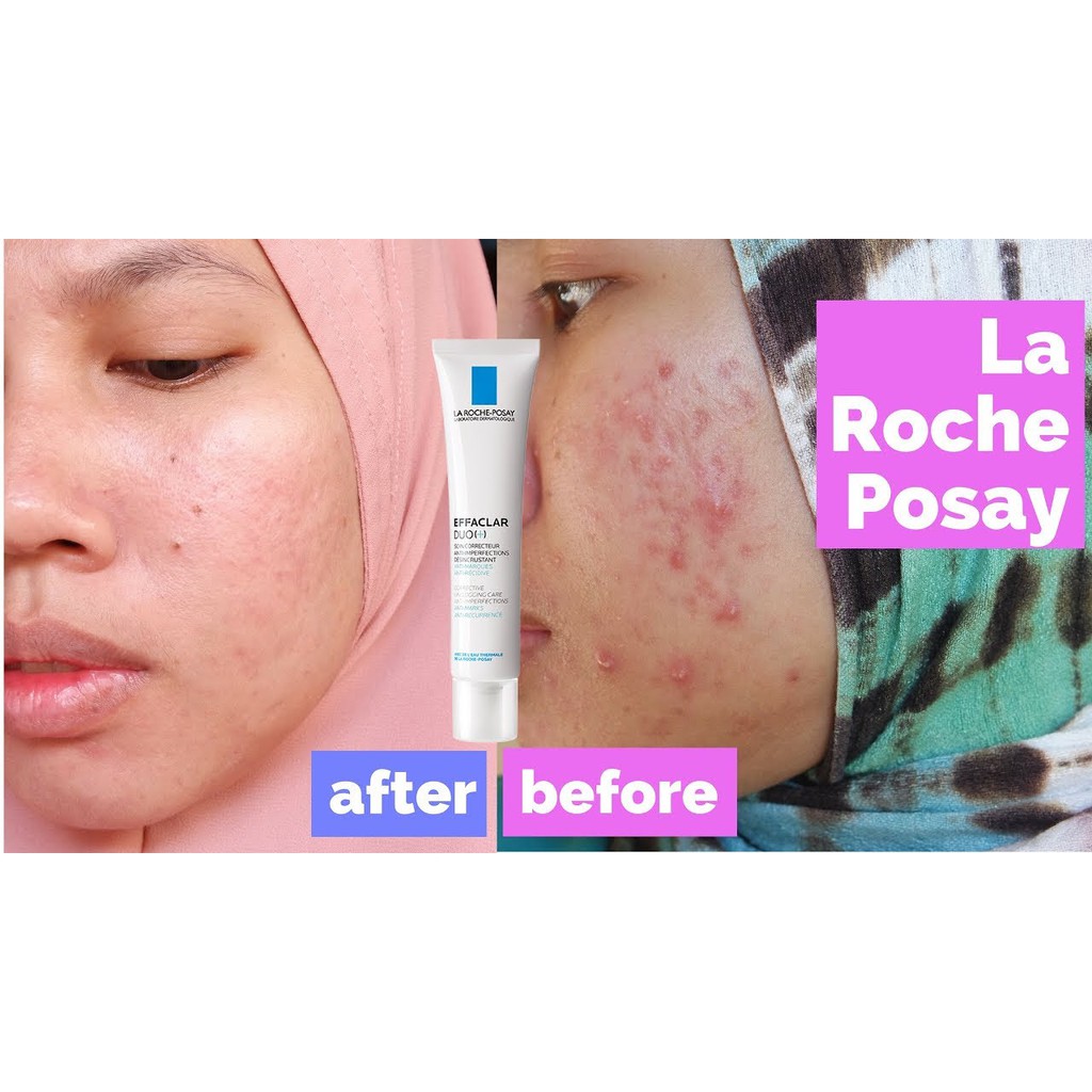 La Roche Posay - Kem dưỡng da giảm mụn, ngăn ngừa vết thâm và ngăn mụn tái phát Effaclar Duo+ 3ml - 15ml - 40ml | BigBuy360 - bigbuy360.vn