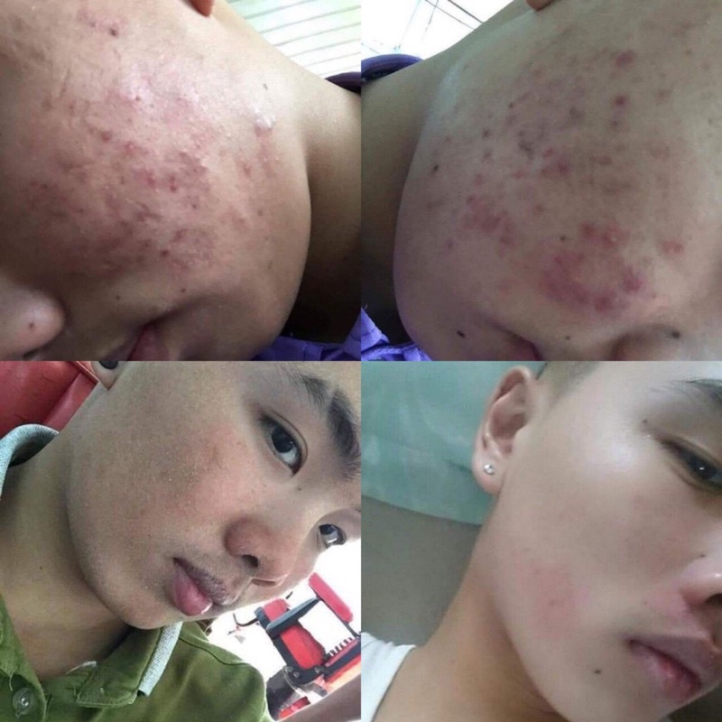 Kem Mờ Sẹo Thâm Sẹo Lõm Và Sẹo Rỗ Của Mỹ Scar Esthetique 30ml- Rejuvaskin