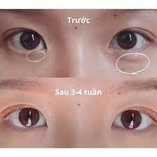 Gel xóa thâm quầng mắt Yanhee Eye Gel giúp mờ nếp nhăn, xóa vết thâm và bọng mắt 5g